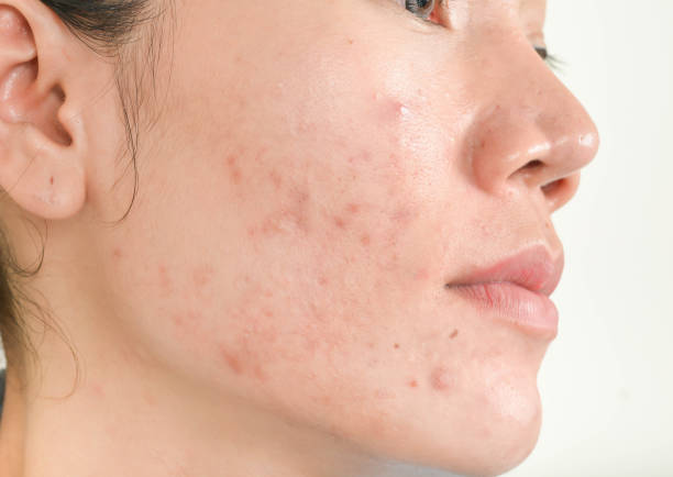 best pimples treatment clinic in bhubaneswar close to kims hospital